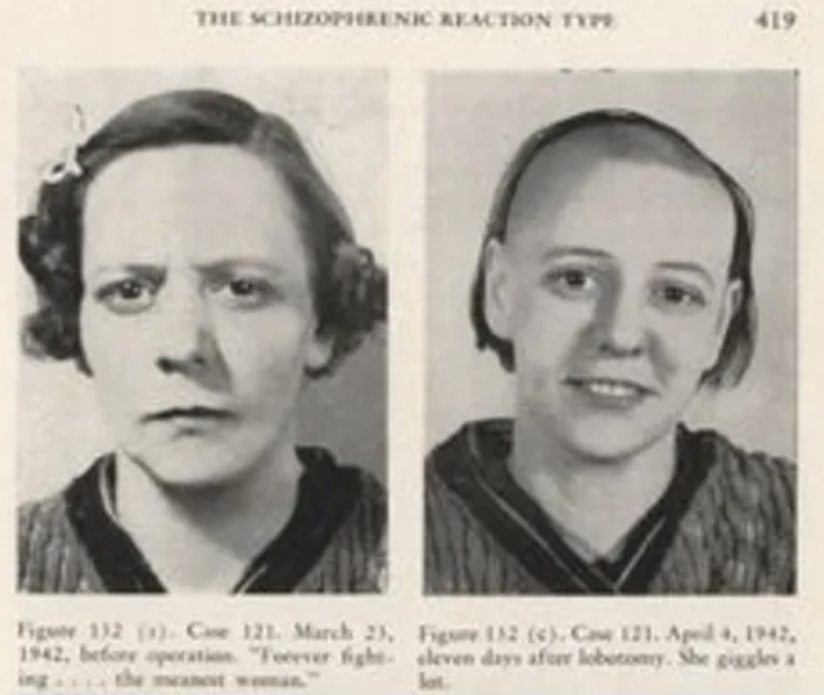 lobotomy 1950s - The Schizophrenic Reaction Type 419 Figuer 132 1. Case 121. , before operation "Teeever fighe ing the the meanest w Fig 132 6. Caw 121. , eleven days aforr lobotomy. She giggles a lot.